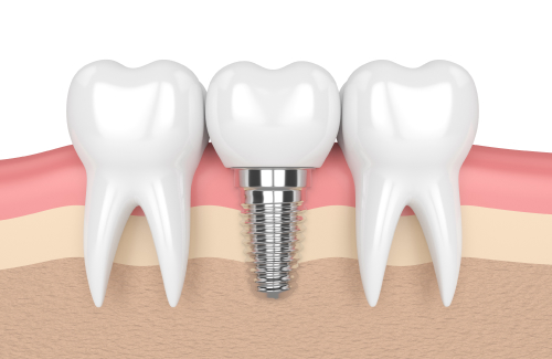 Как правильно ухаживать за зубными имплантами?