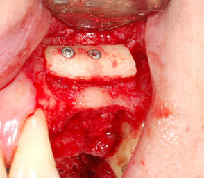 Пересадка костной ткани в область верхней челюсти слева для восстановления толщины