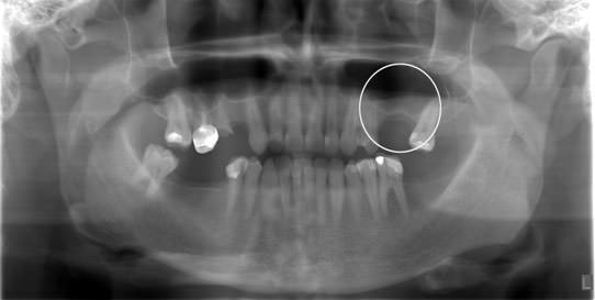 Ортопантомогорамма до операции. Состояние кости в области верхней челюсти. Толщина 2 мм.