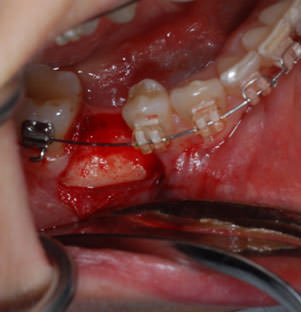 Слизистая откинута, обнаружен дефицит диаметра кости нижней челюсти 45 зуба.