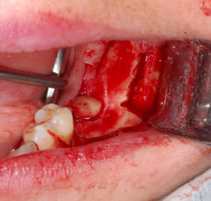 Удаление 36 зуба и костная пластика